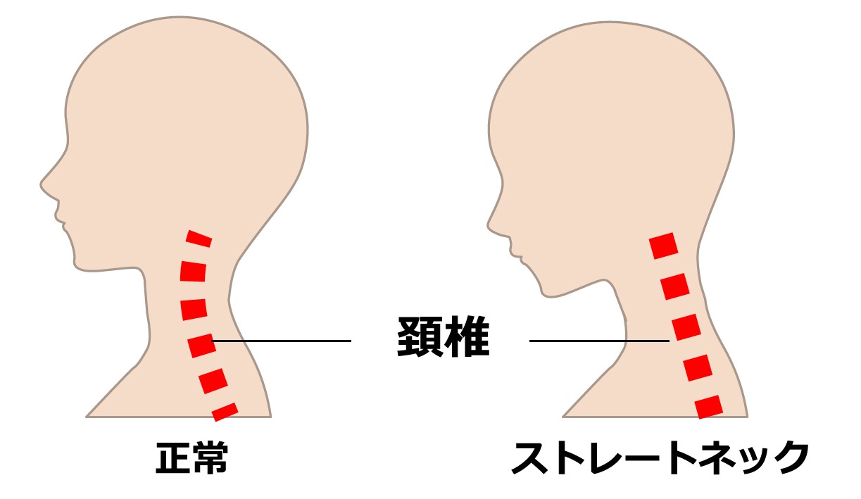 ストレートネック